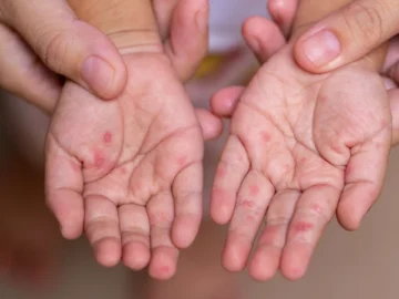 İngiltere’de Kızamık Nedeniyle İki Çocuk Hayatını Kaybetti